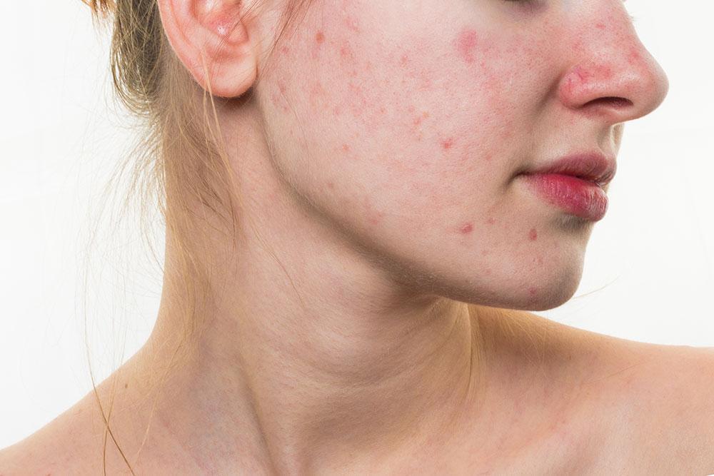 Acné, eczéma, brûlures...